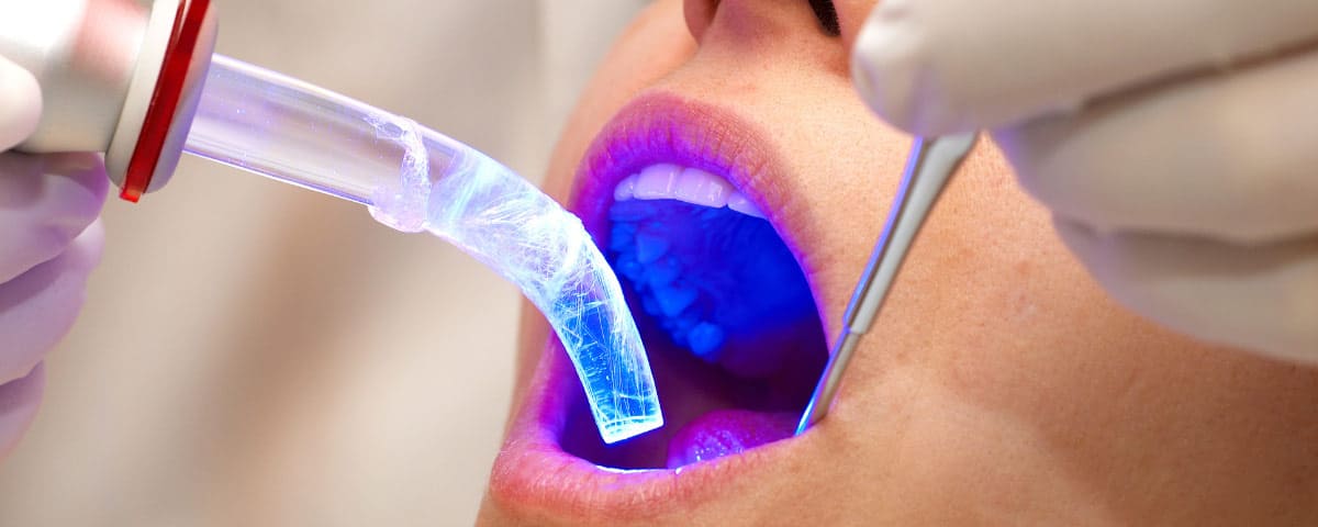 Trattamento dentale con terapia laser per una chirurgia meno invasiva ad Acqui Terme