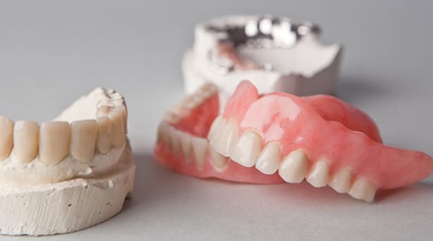 Alcune protesi ed impronte dentali